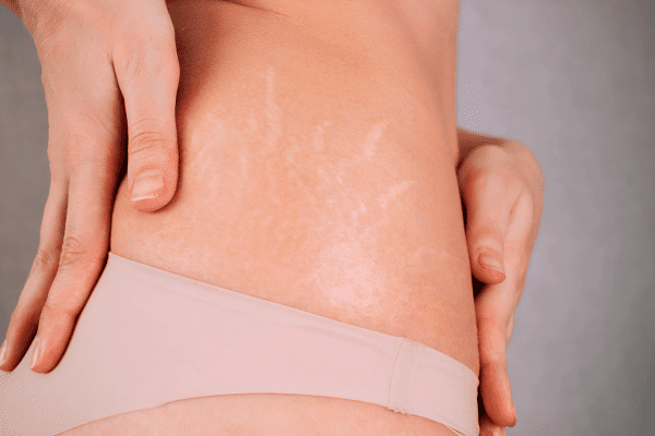 5-Day Stretch Mark Remedy: World's Best Miracle to Erase Marks Fast!