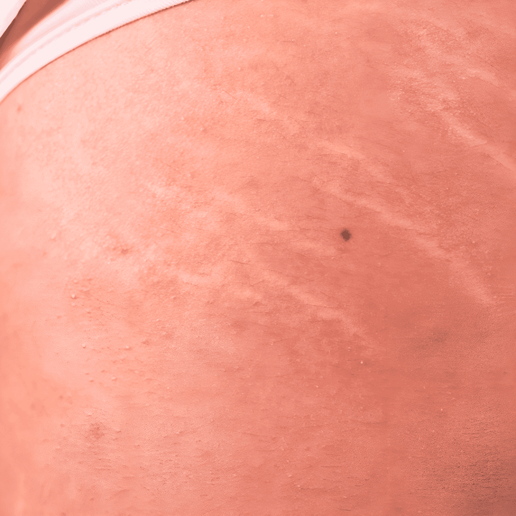 Stretch Mark Remedy
